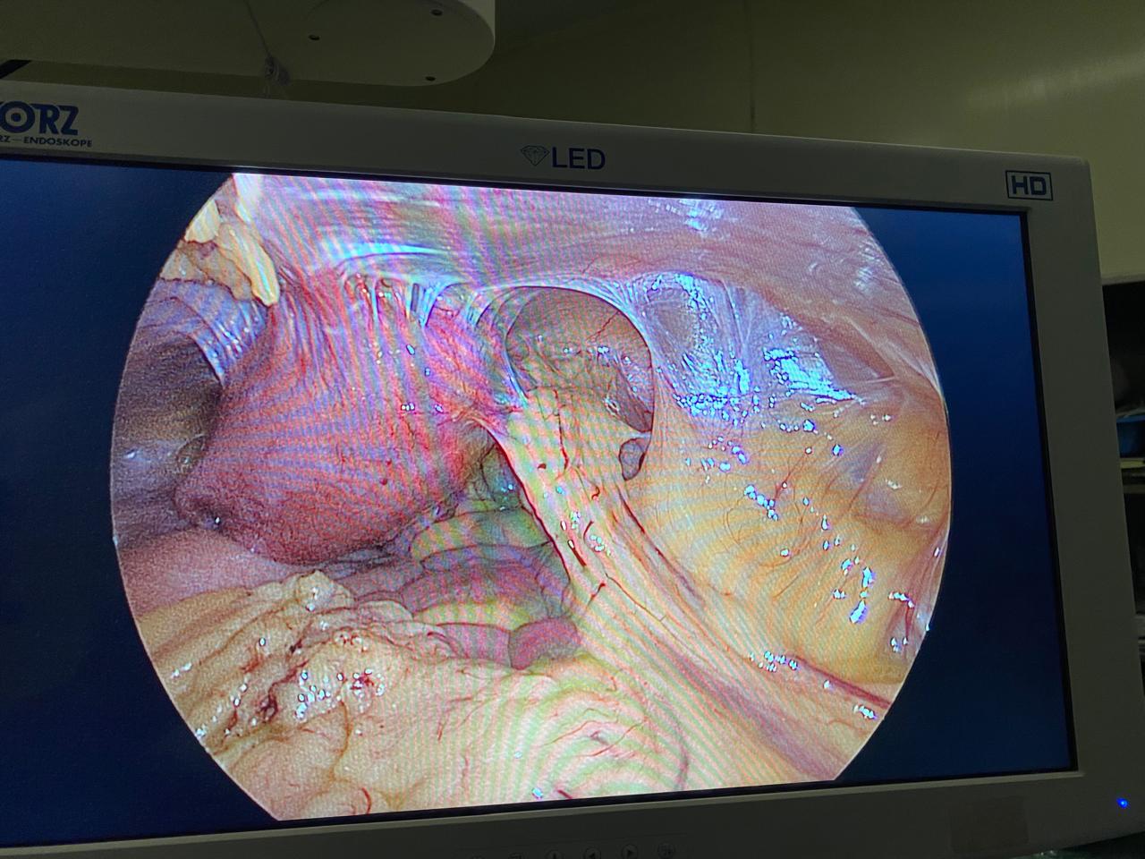 Retroflexed Adherent Uterus