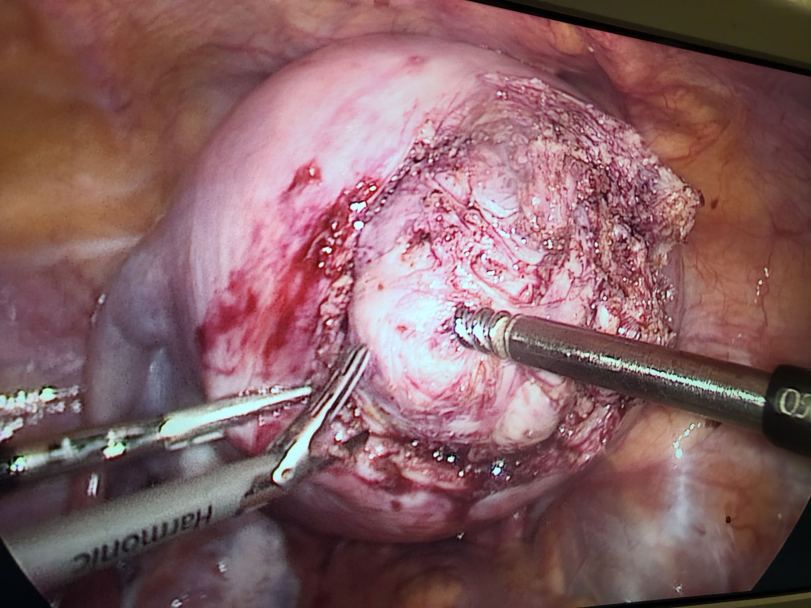 Postmenopausal Bleeding