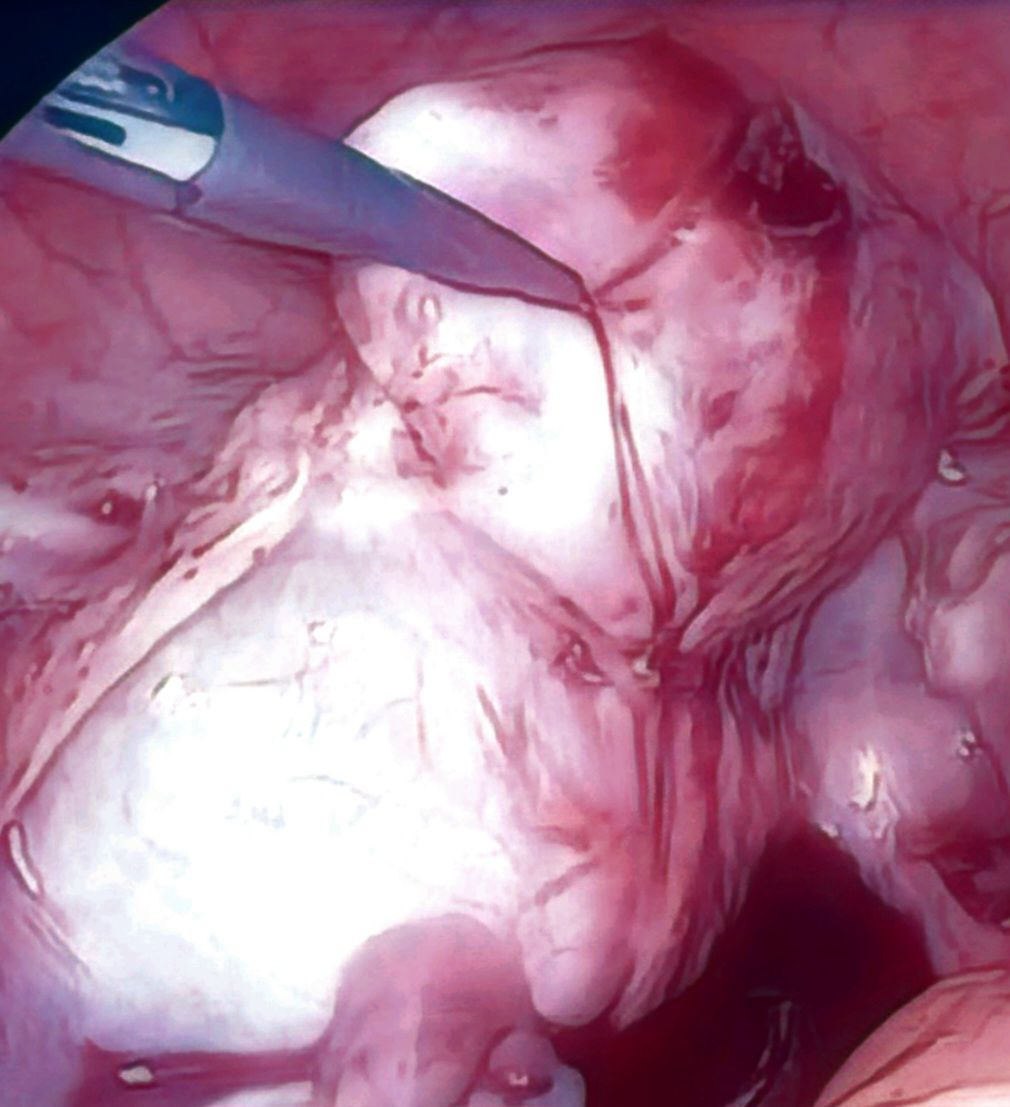 Postmenopausal Bleeding